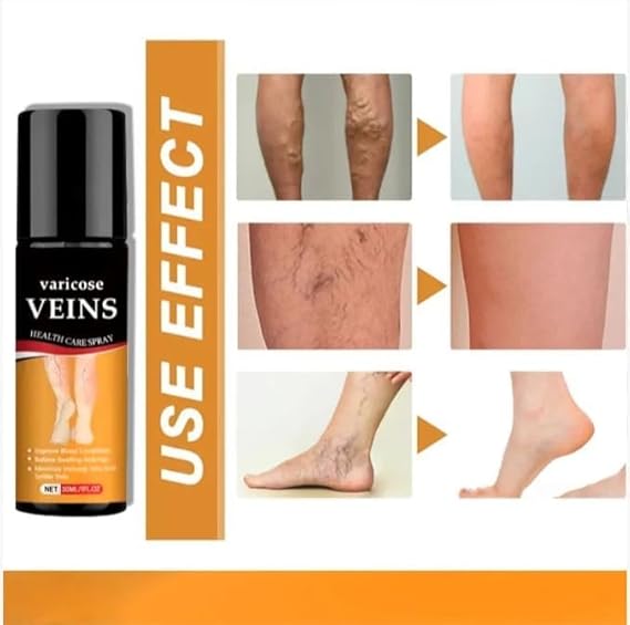 Vericose Vein Pain Relief spray