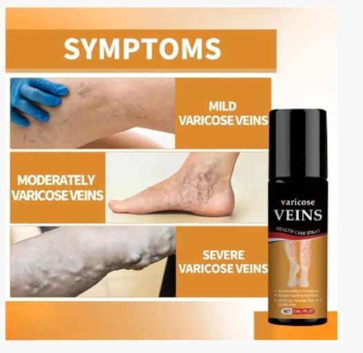 Vericose Vein Pain Relief spray